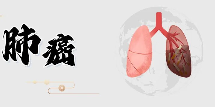 29岁女子干咳一周确诊肺癌！生活中出现4种咳嗽尤要注意