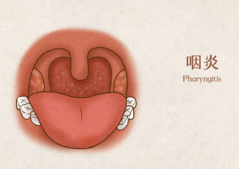 咽炎的症状有哪些？