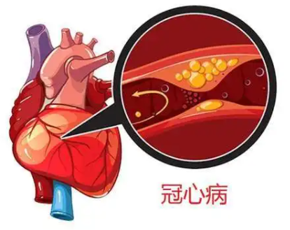 冠心病是怎么引起的？