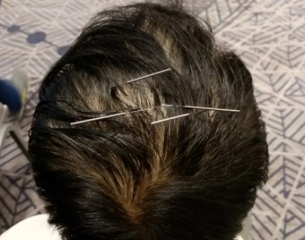 头针的作用与功效有哪些？