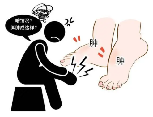 吃什么可以消除水肿？
