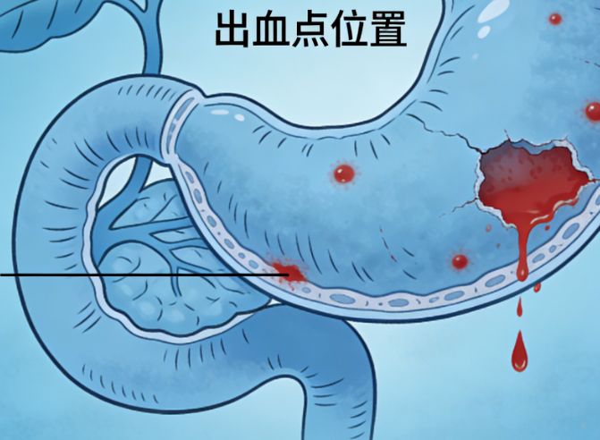 胃出血后怎么办？3个护理要点要知道！
